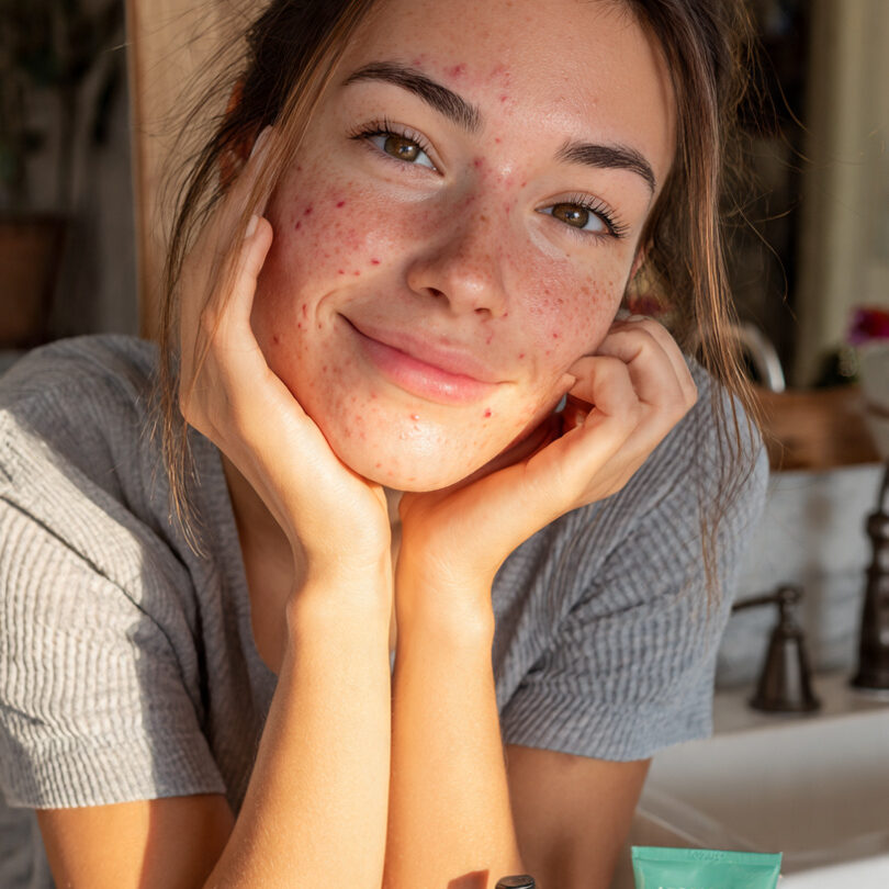 Best moisturizer for dry acne-prone
