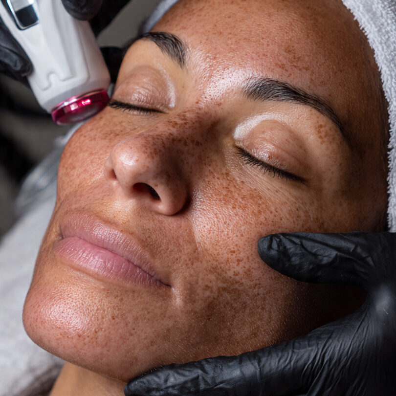 These 8 Lasers Are Safe for Melanin-Rich Skin